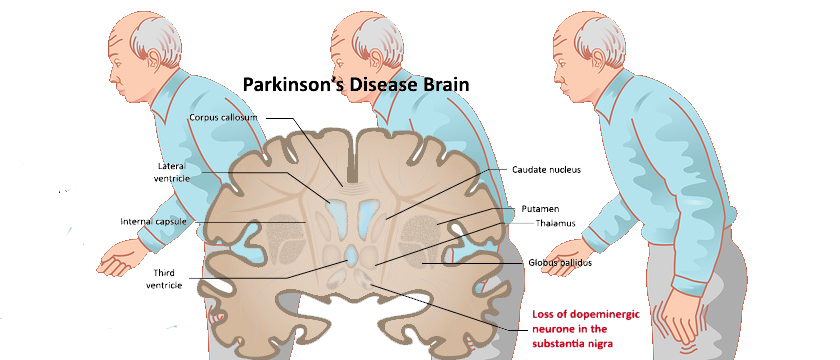 parkinson's disease