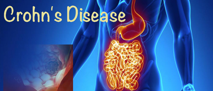 Crohn's disease