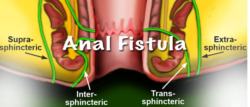 anal fistula