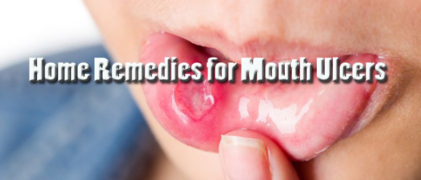 home remedies for mouth ulcers